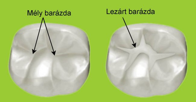 barázdazárás, mély barázda, lezárt barázda