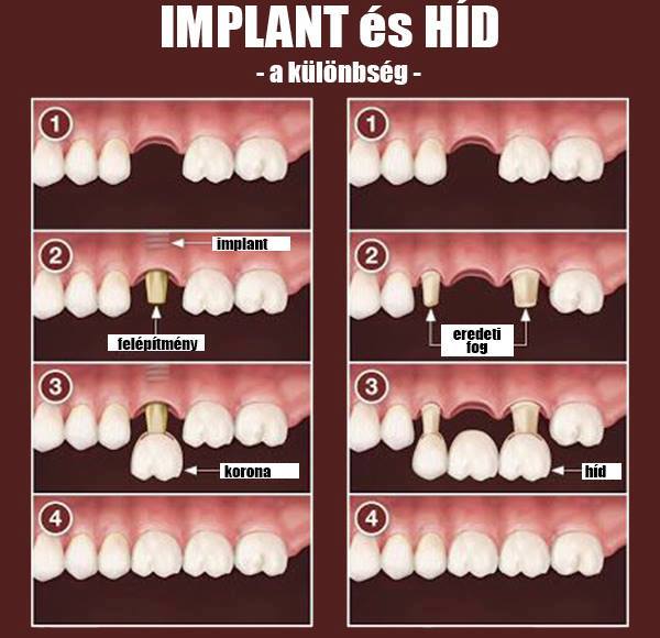 fogászati implant és híd