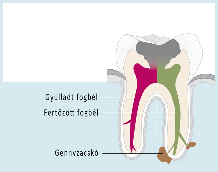 gyokerkezeles-fog-metszet