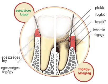 egészséges fog és fogínygyulladás