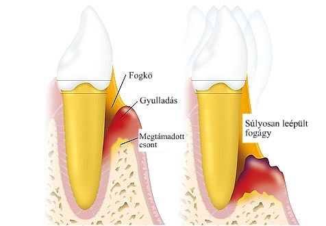 parodontitis_fogínysorvadás