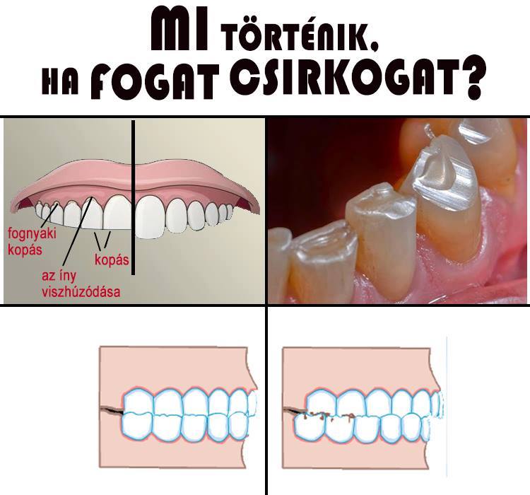 fogcsikorgatás következményei