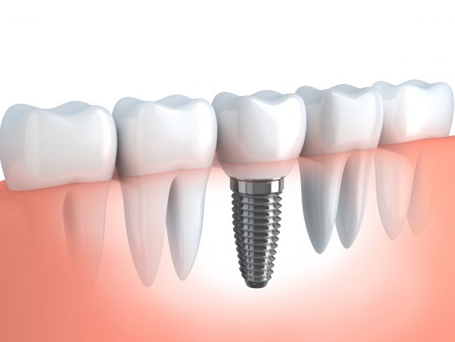 fogászati implantátum