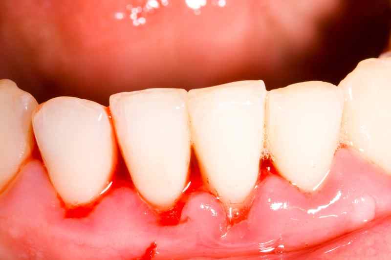 Összegyűjtöttük a fogínygyulladás tüneteit és figyelmeztető jeleit | parodontax